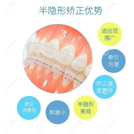 郑州马泷齿科做陶瓷自锁矫正价格不贵