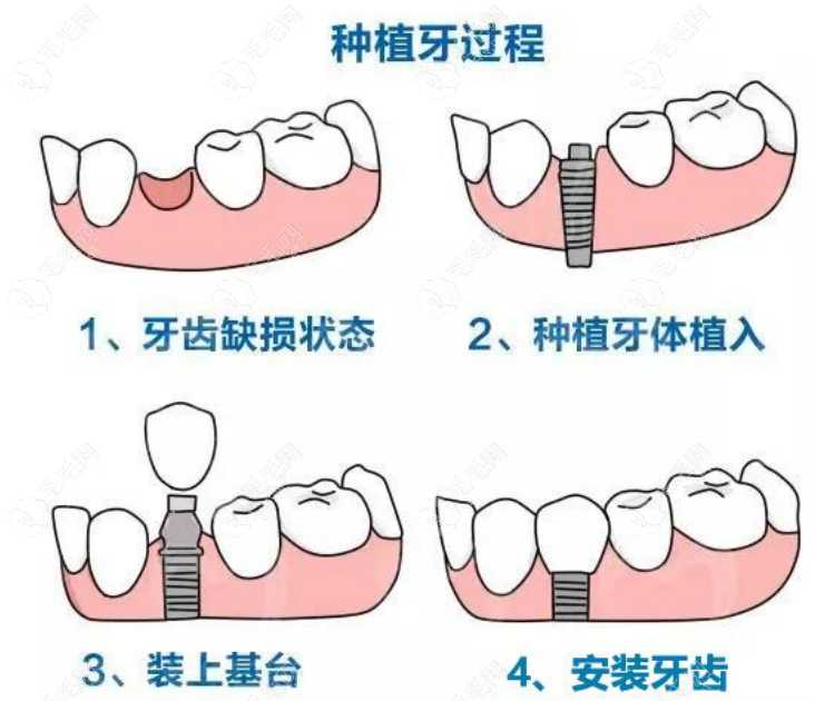 种植牙示意图