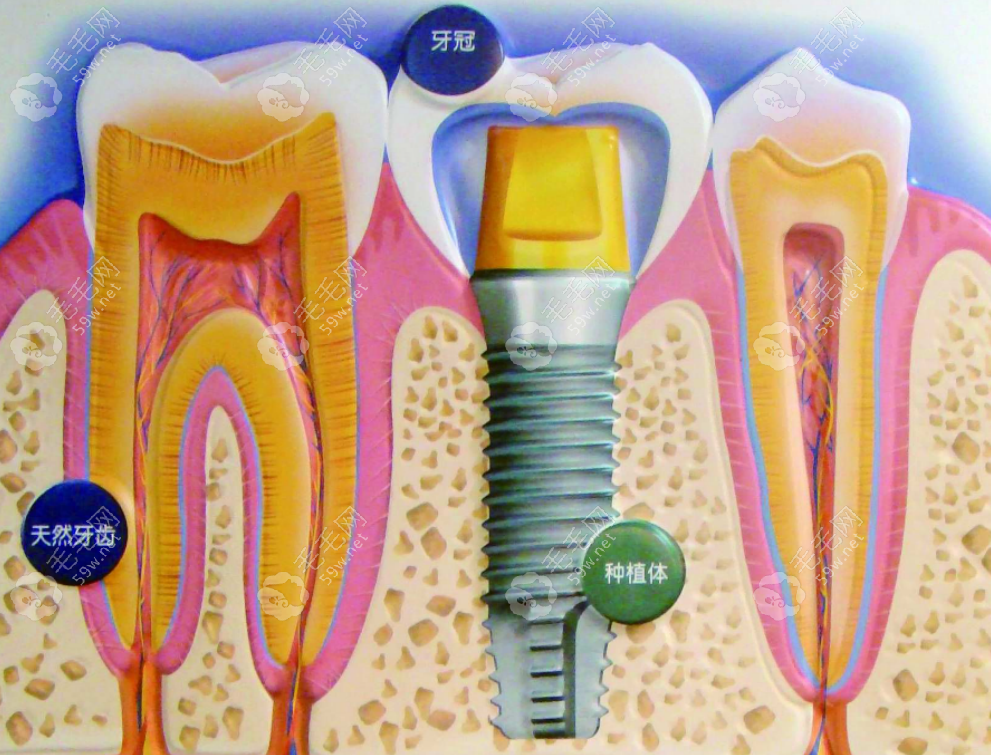 种植牙示意图