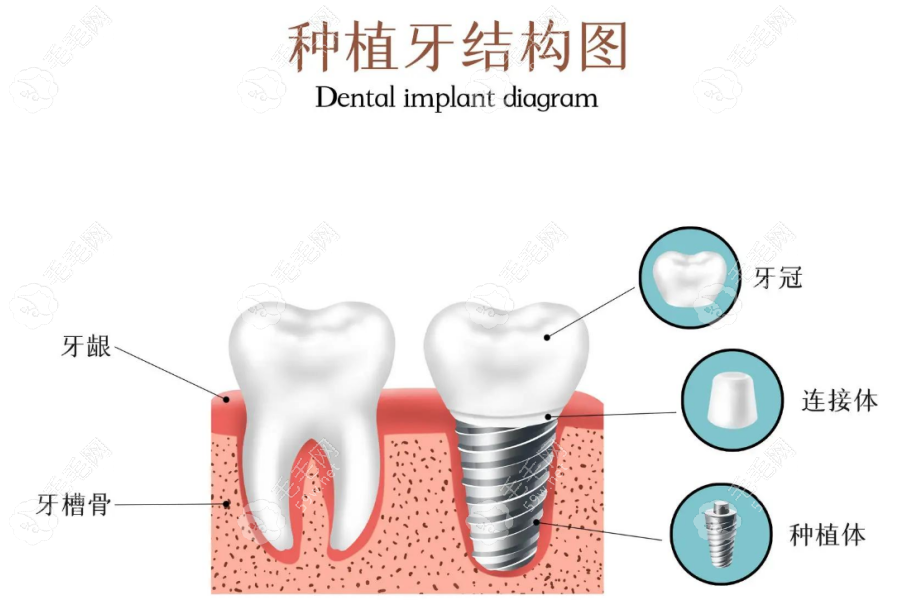 种植牙示意图