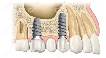 沈阳德立联合口腔种植牙价格:数字化种植牙解决方案2980元+