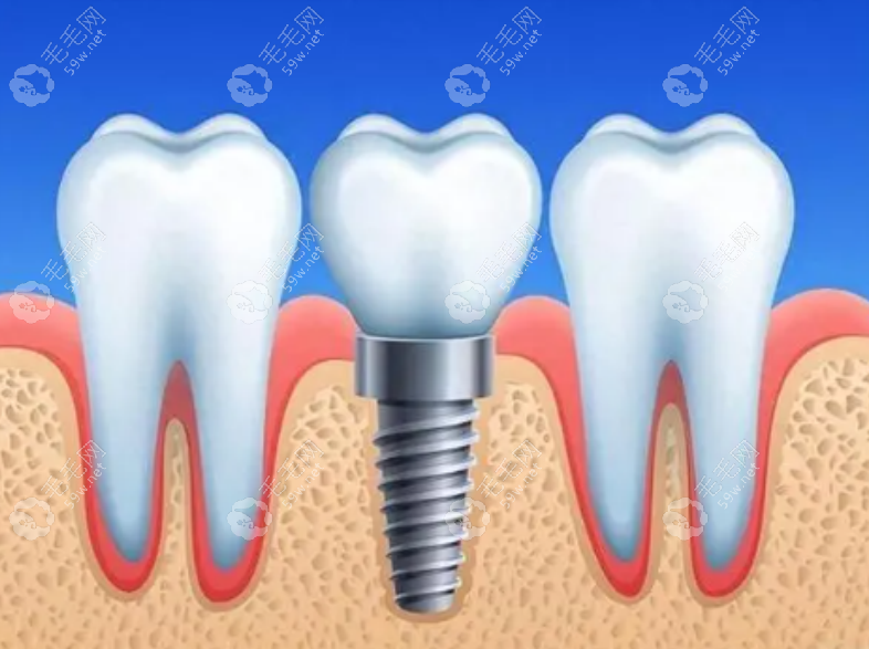 种植牙手术示意图