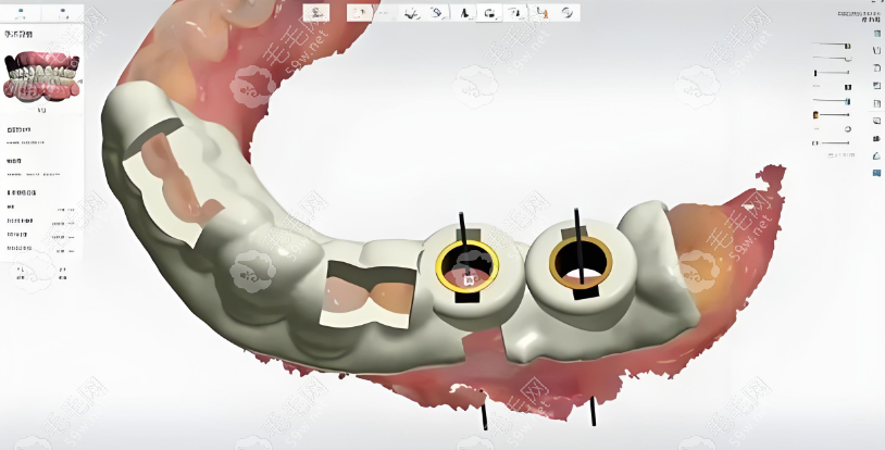  3D导板数字化种植牙技术无需翻瓣 m.59w.net