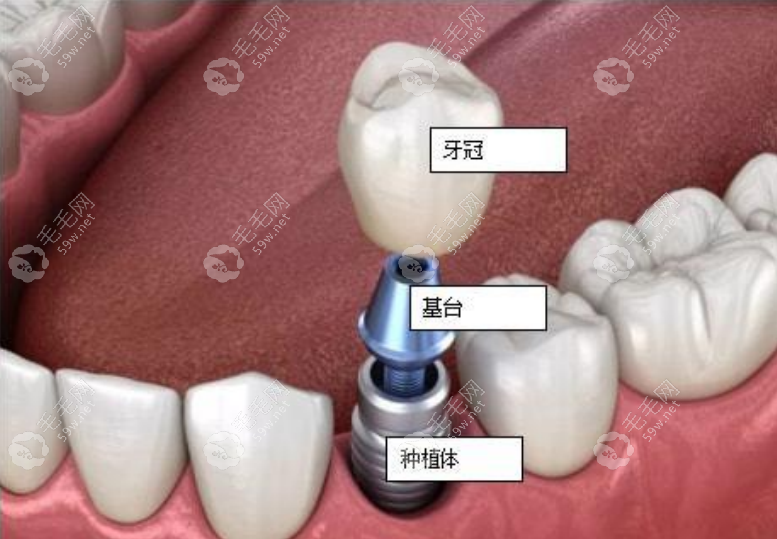 种植牙手术示意图