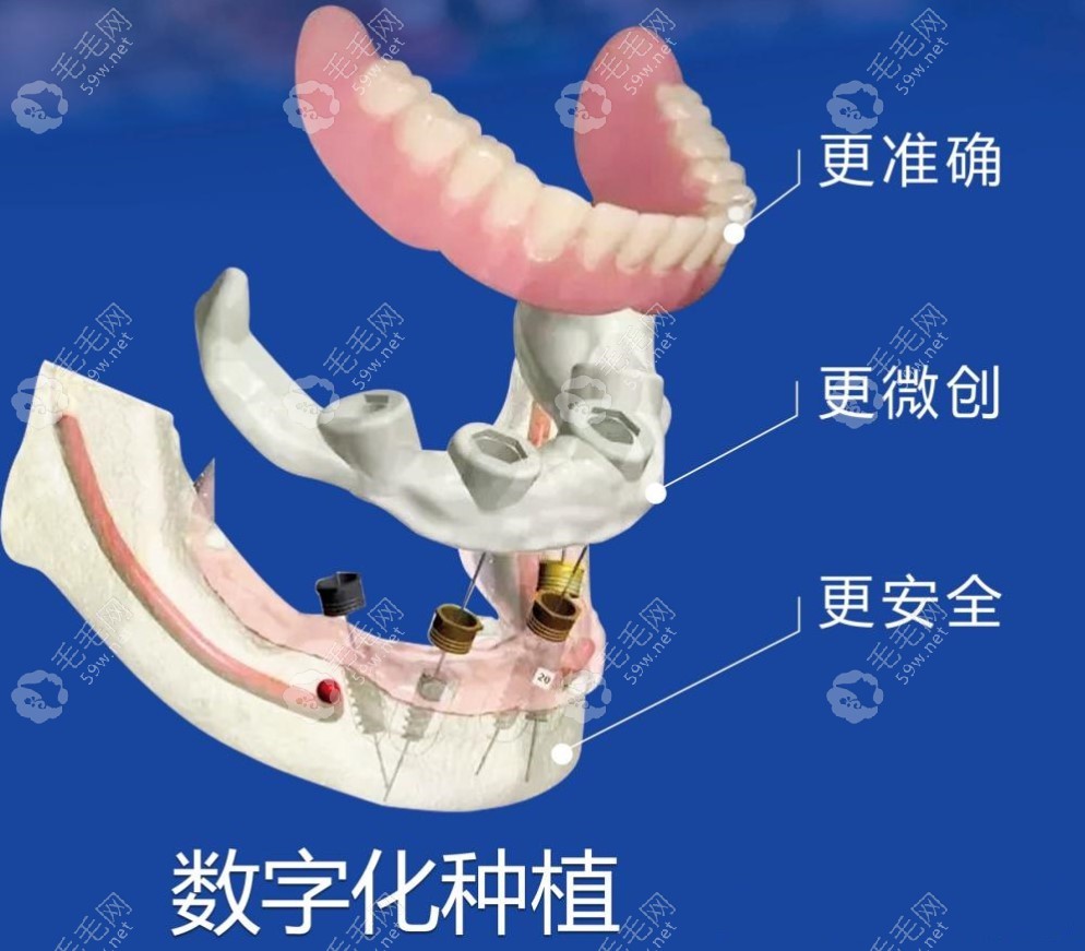 3D导板数字化种植牙技术靠谱 毛毛网