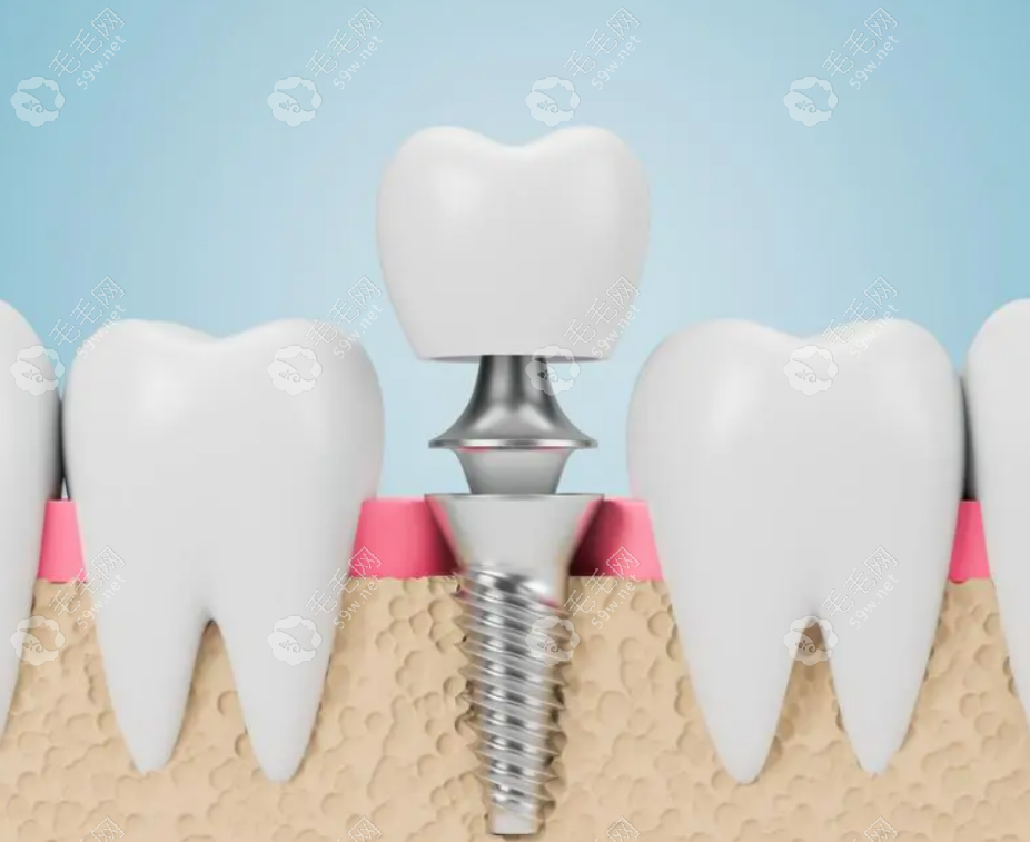 种植牙手术示意图