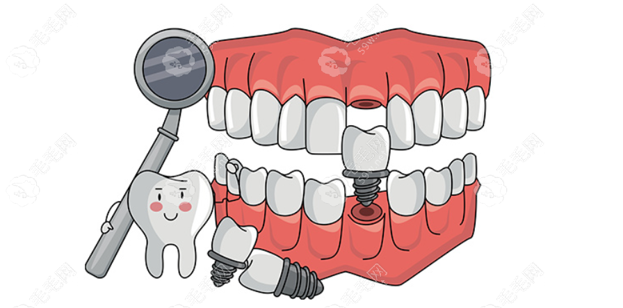 南阳全口种植牙价格多少钱 毛毛网