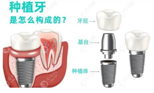 即刻种植牙是当天就装牙冠吗