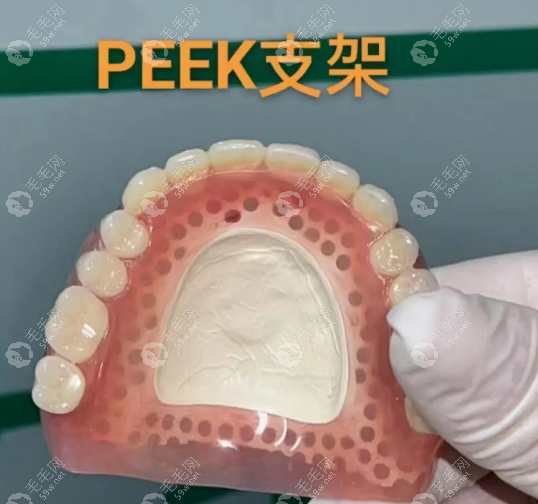 peek支架活动义齿的优势