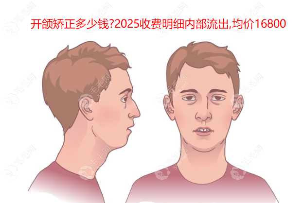 开颌矫正多少钱?2025收费明细内部流出,均价16800,前后对比大