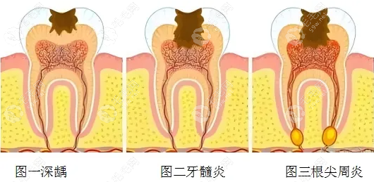 大牙牙髓炎怎么办