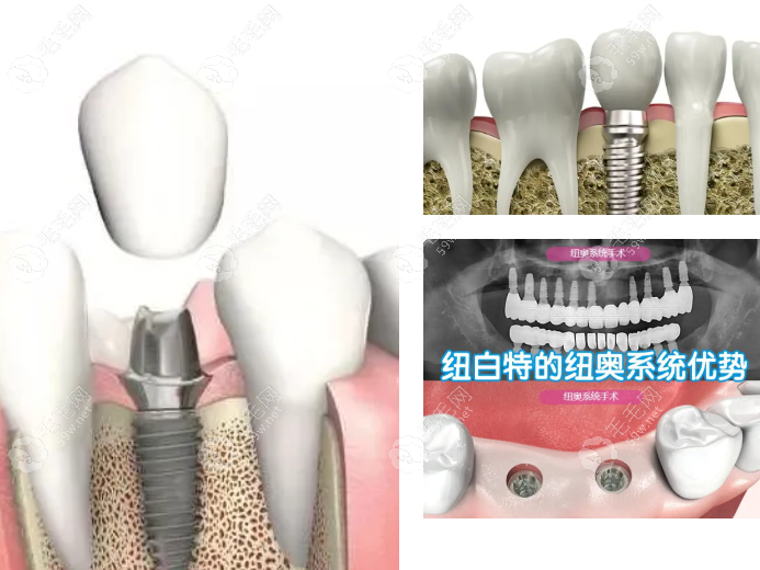 韩国neo种植牙多少钱一颗