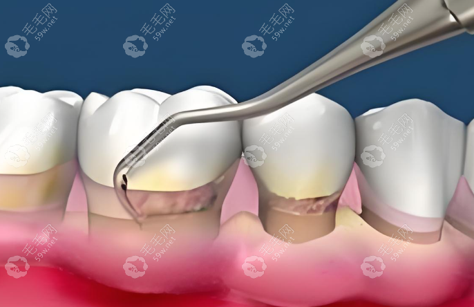 龈下刮治有必要吗?牙周炎有必要,一般没那么痛苦好处消牙石