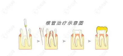 根管治疗后牙齿的寿命平均在10年左右,对牙齿的寿命无影响