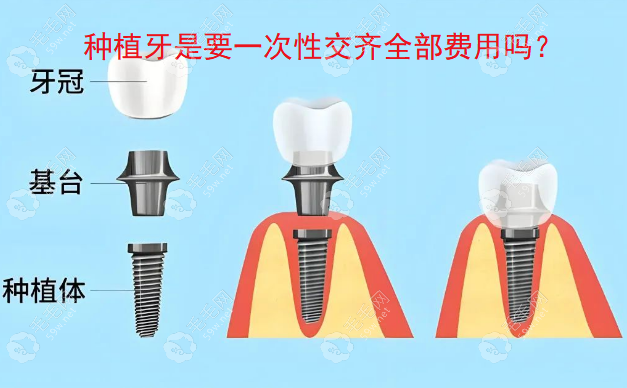 2025年做种植牙是要一次性交齐全部费用吗？价格要多少钱呢?