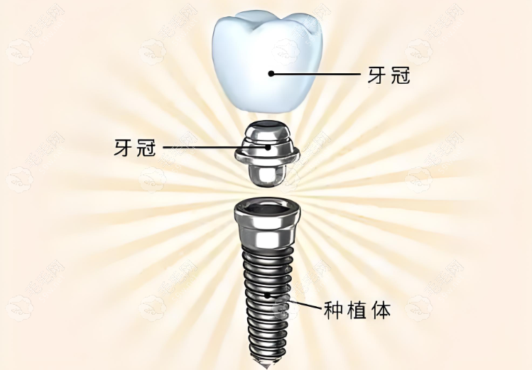 以色列dentin丹特因种植体集采价格4000起,中高端植体不易断~