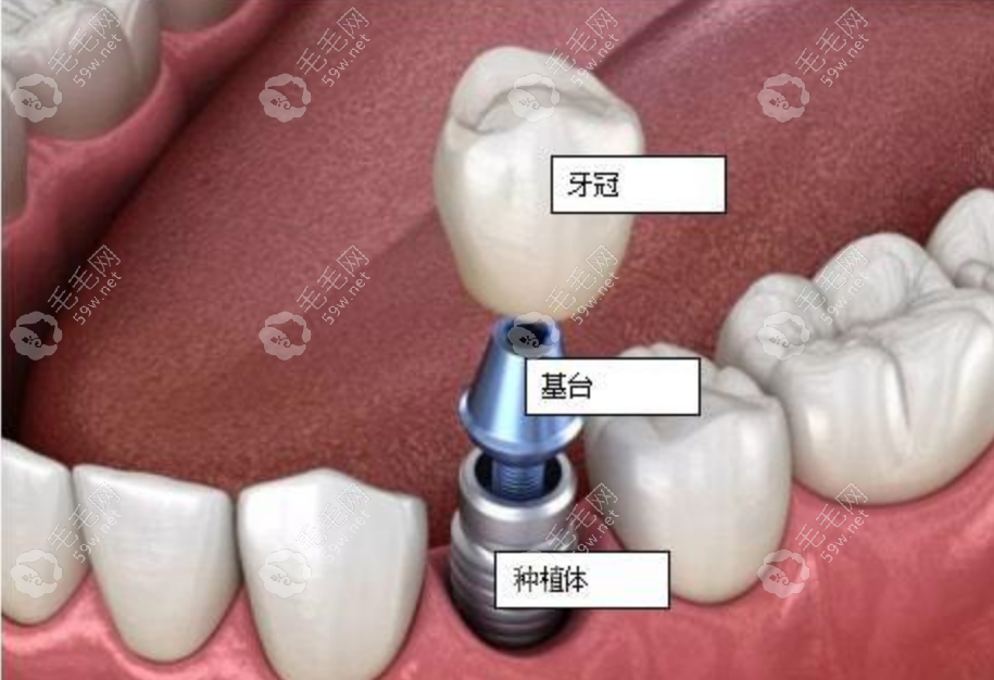 种植牙手术示意图