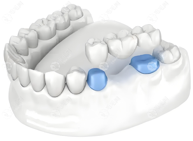 搭桥固定牙多少钱一颗?2024-2025近一年市场统计价格公示可约