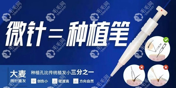 微针毛发移植手术