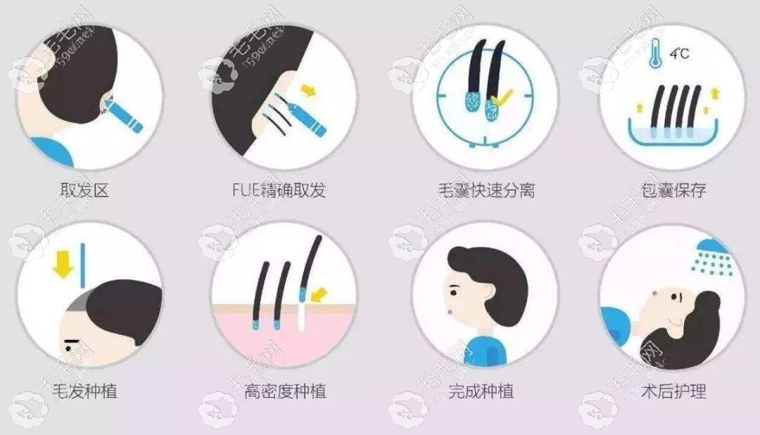 植发的流程