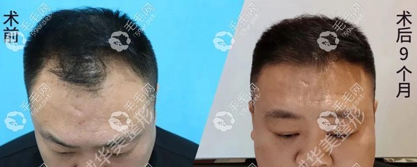 运城华美发际线种植9个月效果