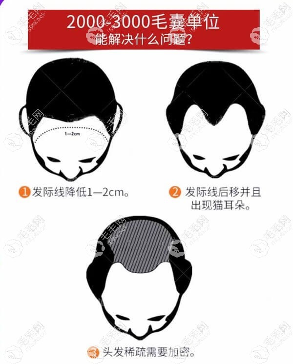 际线植发1厘米/2厘米个需要多少毛囊
