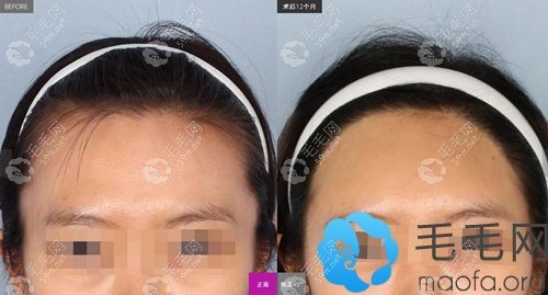 巴诺巴奇发际线种植一年效果图