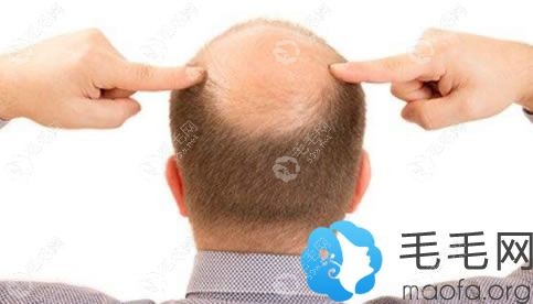 大量掉头发是什么原因导致的