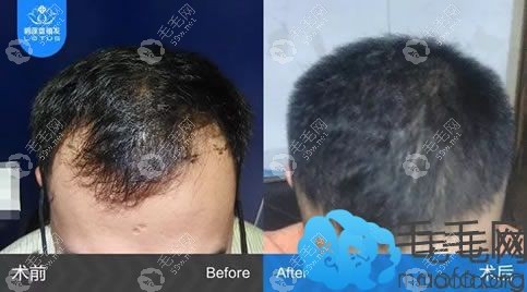 通过植发治疗脱发掉发的案例