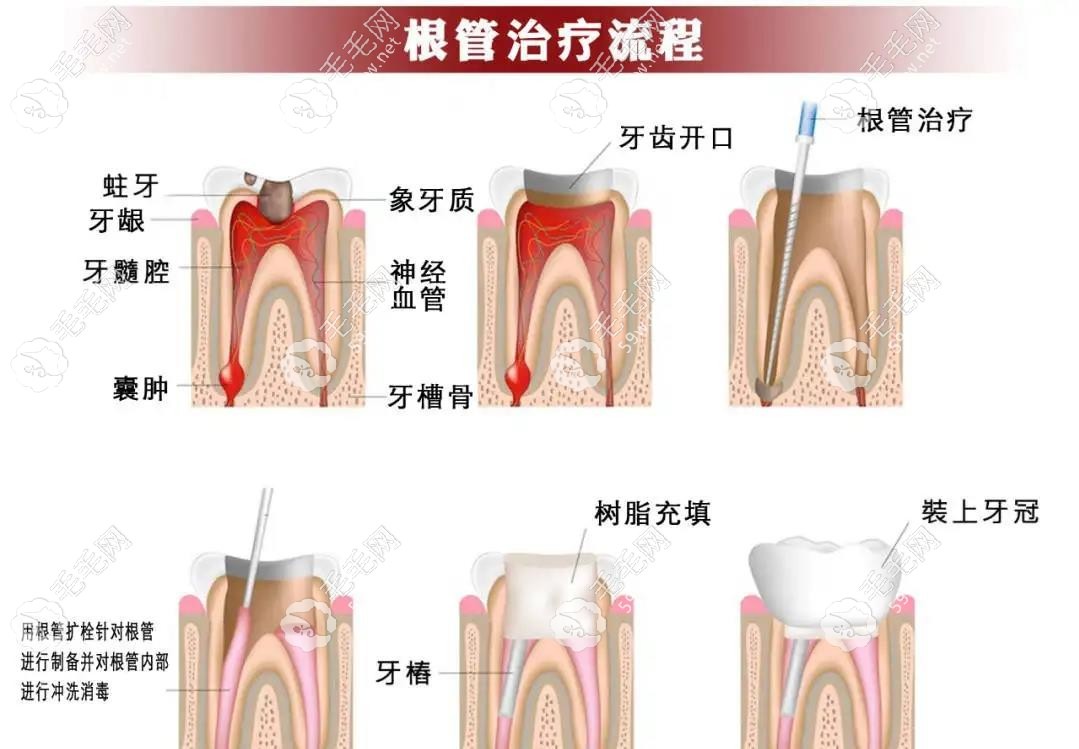 显微镜下根管治疗的优点