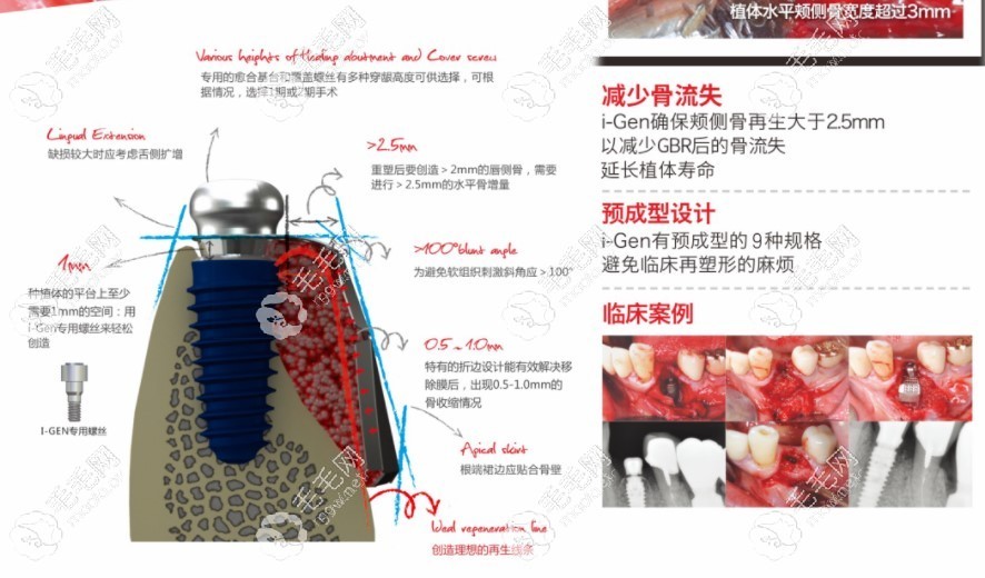 美格真种植体优势及病例