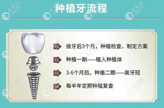 韩系登腾种植体是什么材质质量怎么样