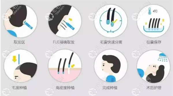 FUE植发技术的技术单价