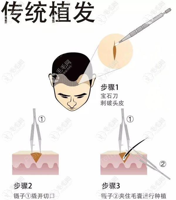FUE无痕植发方式