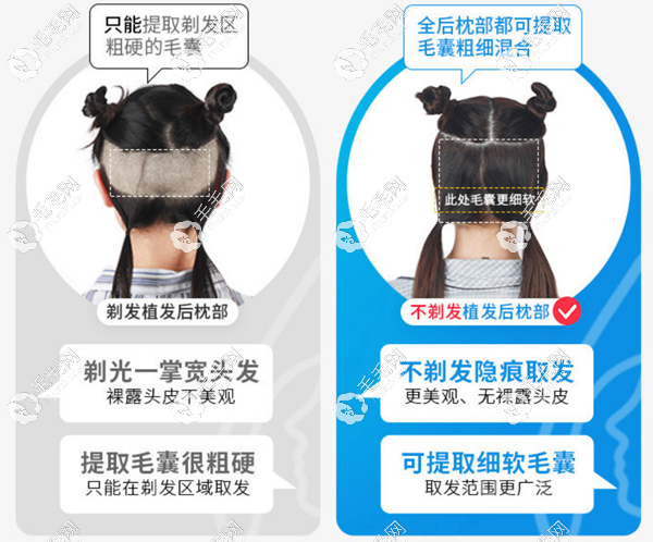 杭州首瑞特色的不剃发植发