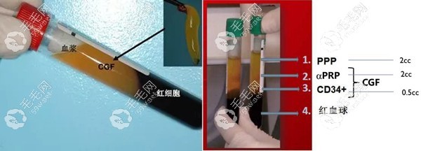 植发CGF治疗中的cgf生长因子