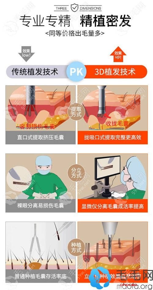 新生3D植发技术优势，取发量多20%
