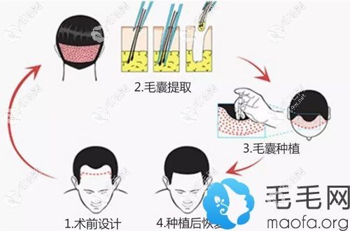 植发手术过程示意图
