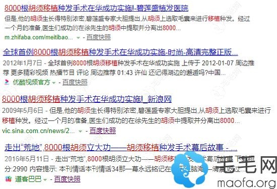 8000胡须移植到头上的案例的相关报道