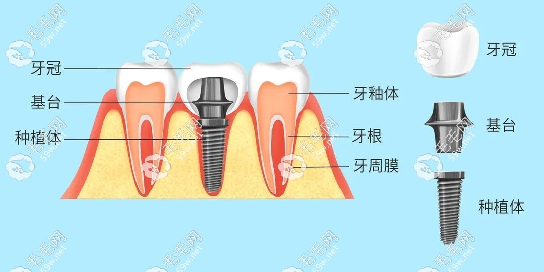 人工種植牙結(jié)構(gòu)解剖圖