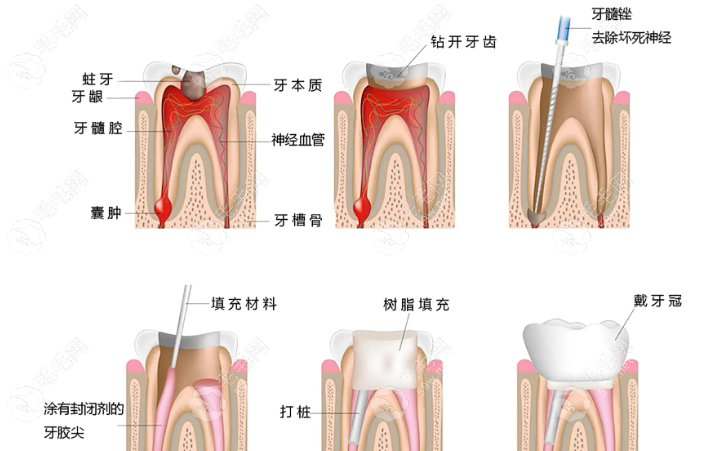 2025济南根管治疗费用:根管治疗一颗牙加牙冠价格低至2000元+  毛毛网