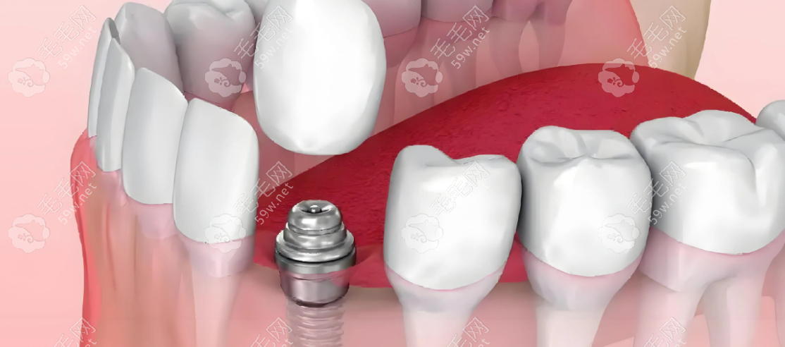 种植牙980一颗是真是假？2025年牙科医院优惠政策全解析  毛毛网