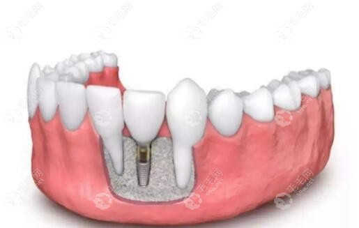 2025武汉种植牙收费标准：种牙一颗便宜的2580元起