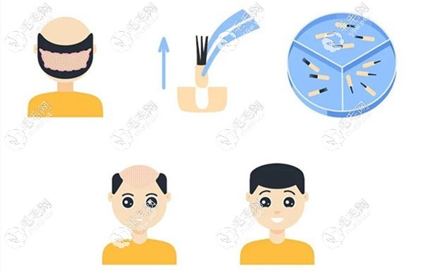 植发手术过程示意图