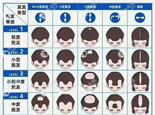 二到四级脱发症状，能恢复到原来吗？