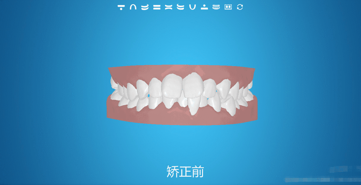 牙齒矯正