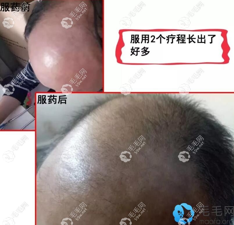 顾客服用2个疗程生发丸据说头发也长出来好多
