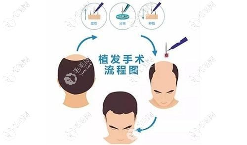成都丝恒植发没有套路
