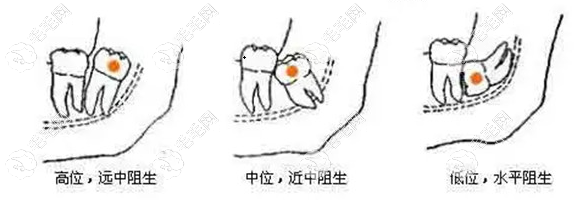 广州被肉包住的智齿大概多少钱