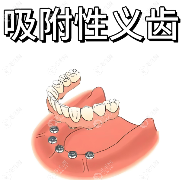北京首口附一口腔吸附性义齿价格